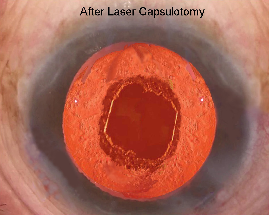 Shrewsbury YAG laser Capsulotomy viswanathan